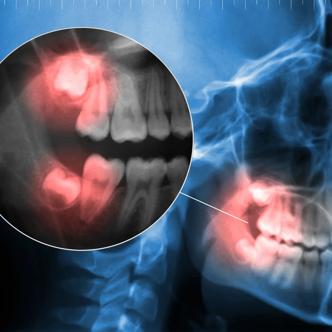 Wisdom Teeth Removal