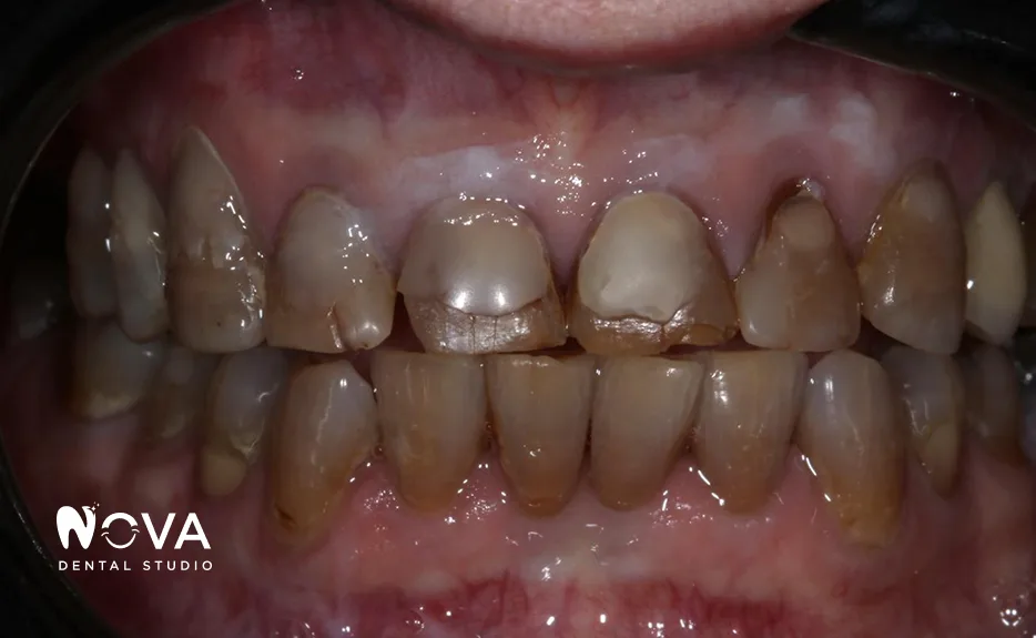 Before