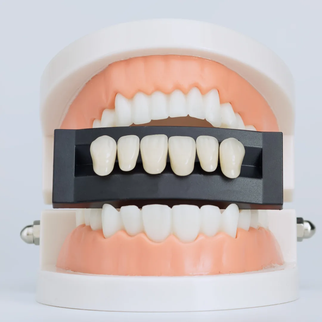 Veneers