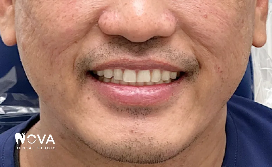 Before