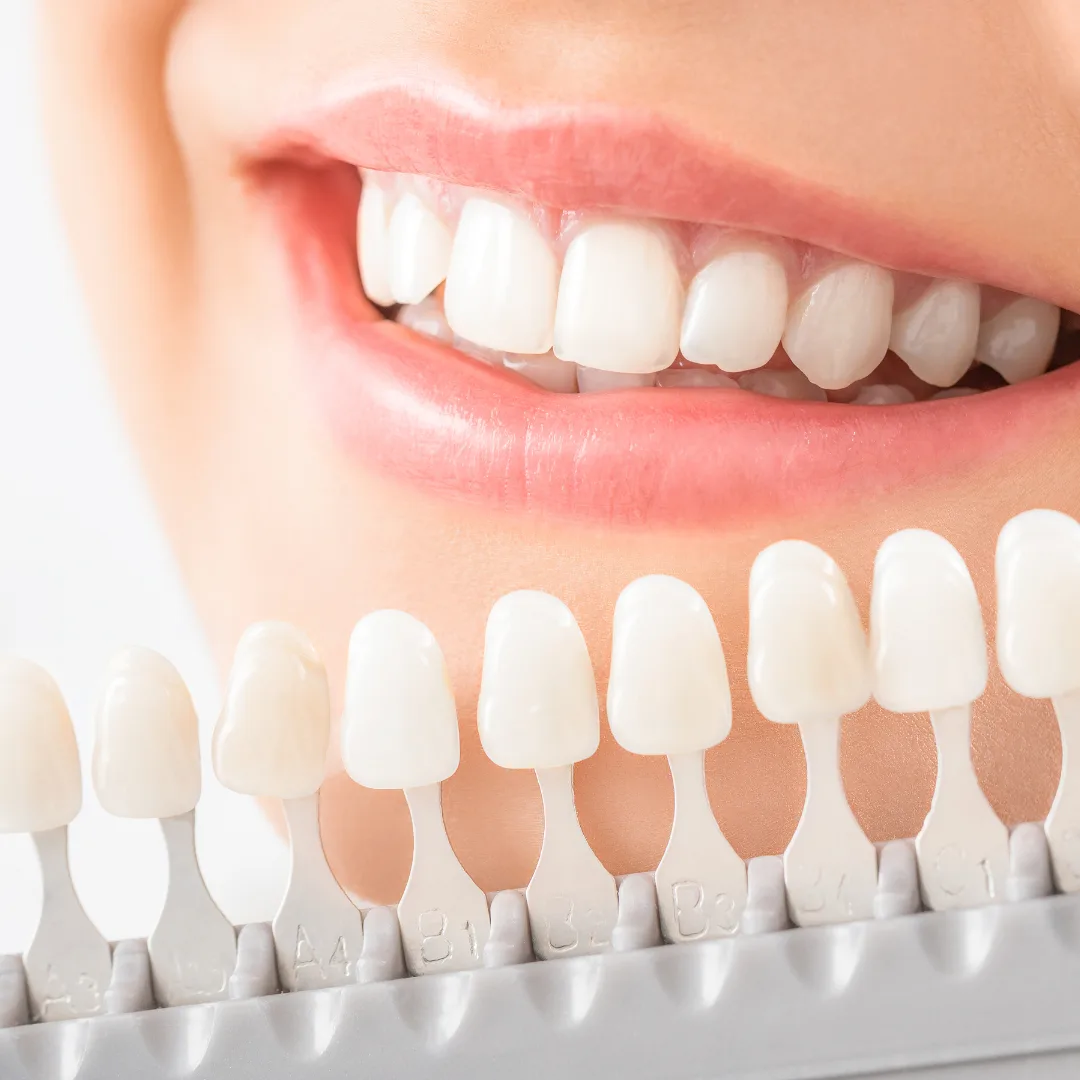 Teeth Whitening