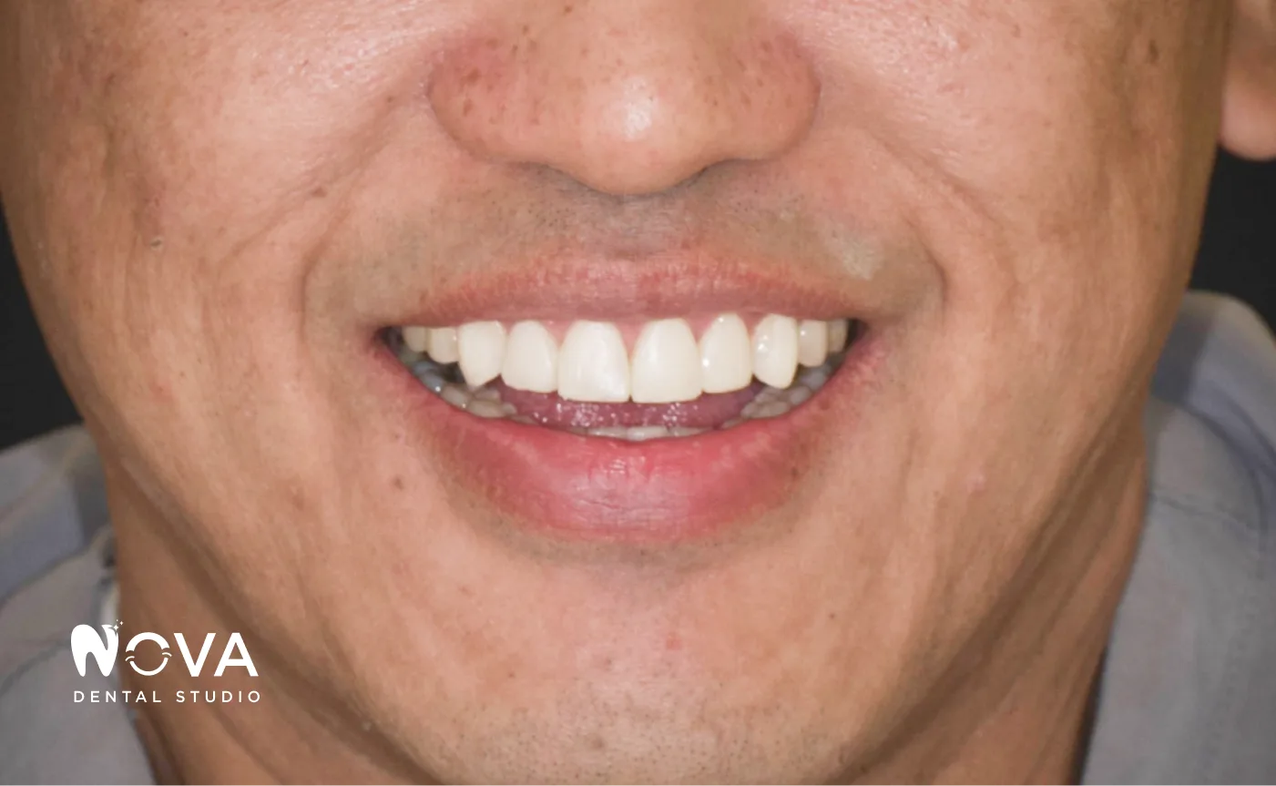 After