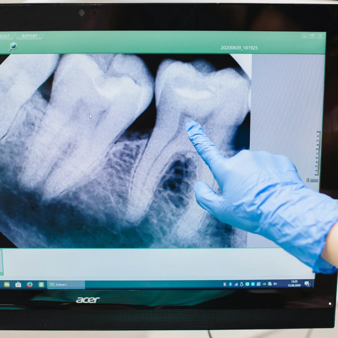 Extraction and Site Preservation/Augmentation